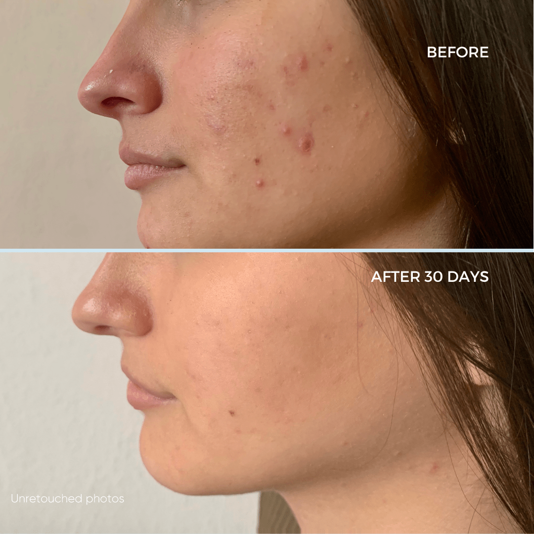 The Science Behind White Willow Bark: How It Helps Prevent and Treat Acne - Rena Roots™
