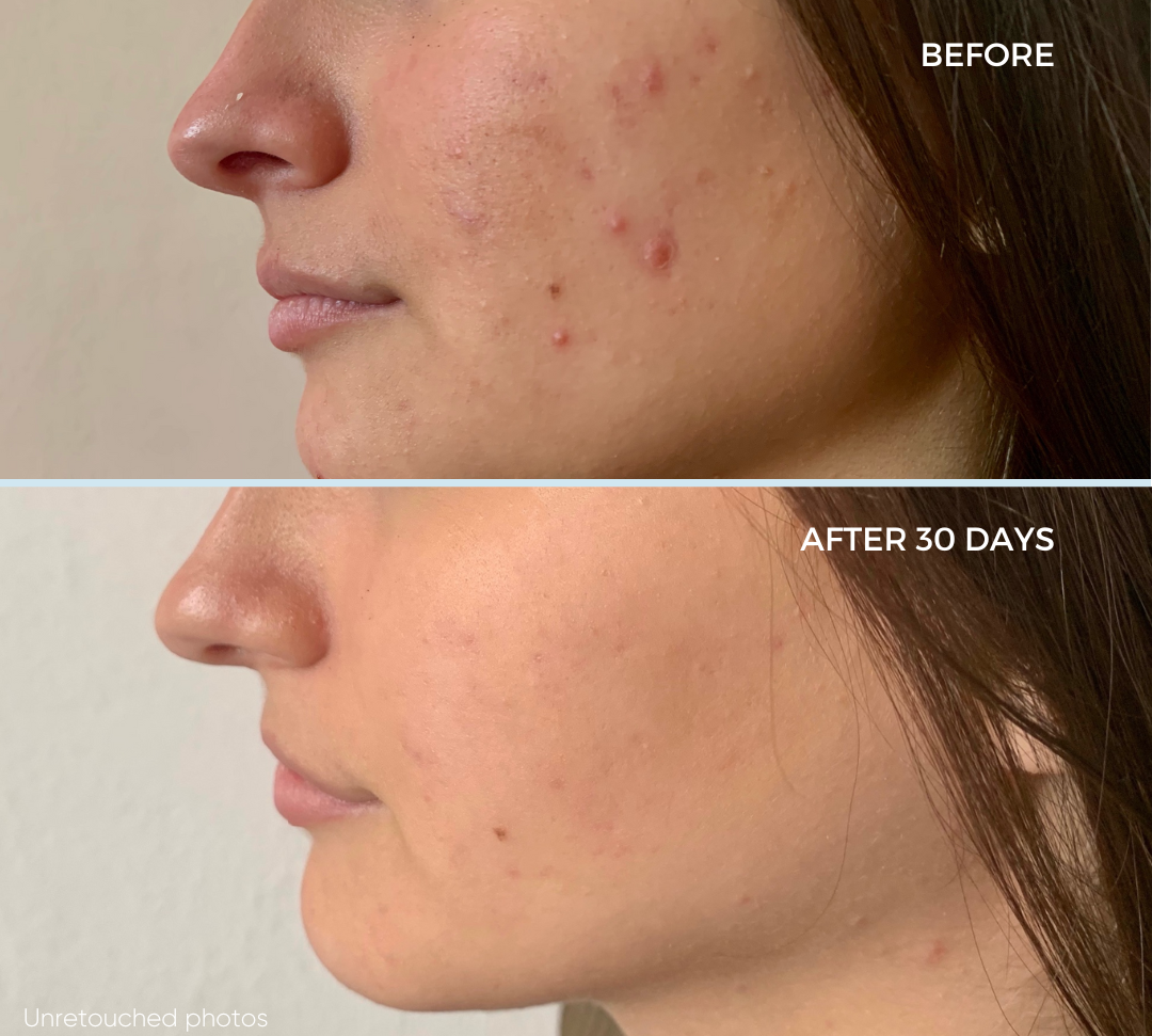 The Science Behind White Willow Bark: How It Helps Prevent and Treat Acne