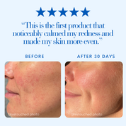 Before and after image of woman's face showing redness and irritation in the before image and calm, radiant skin in the after image