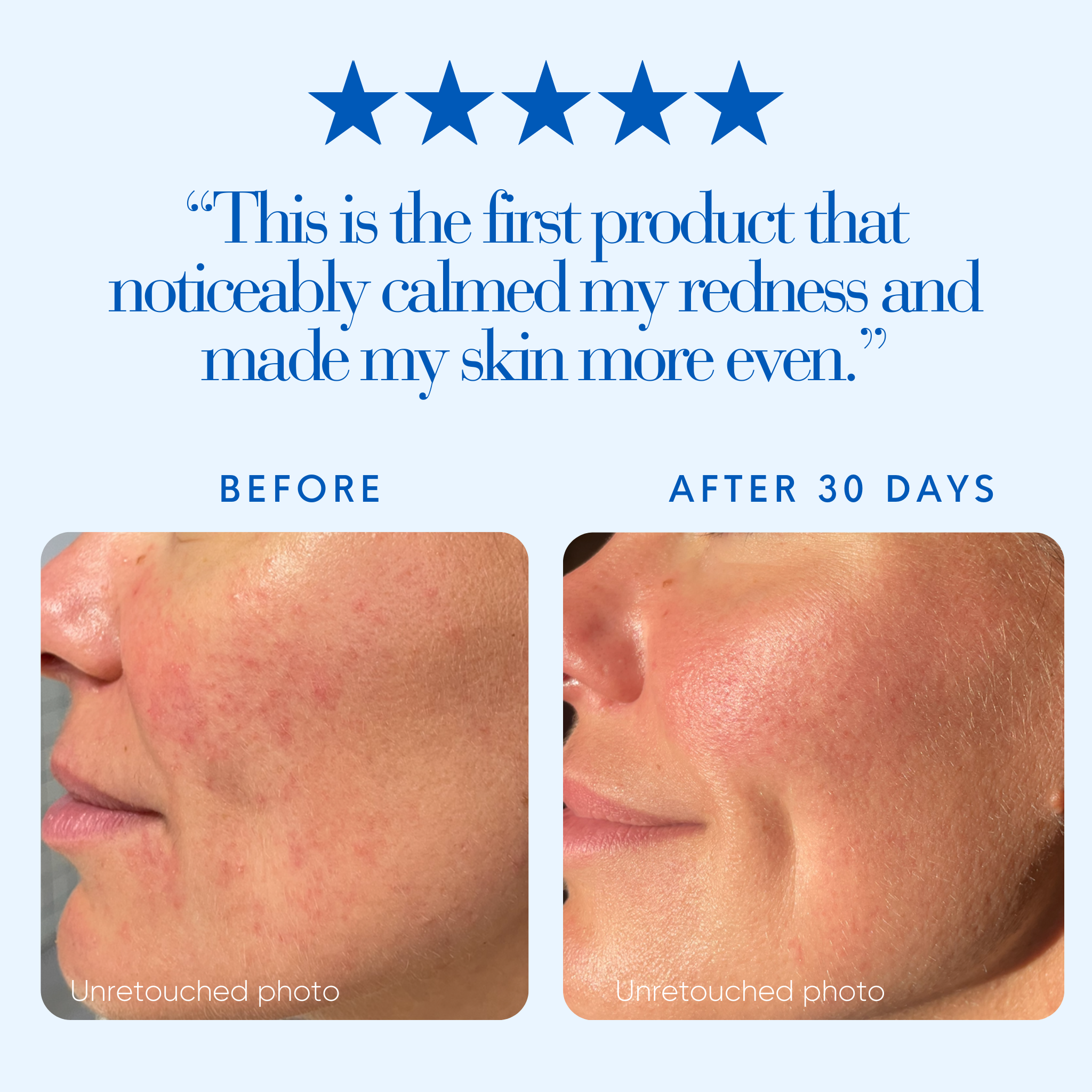 Before and after image of woman's face showing redness and irritation in the before image and calm, radiant skin in the after image