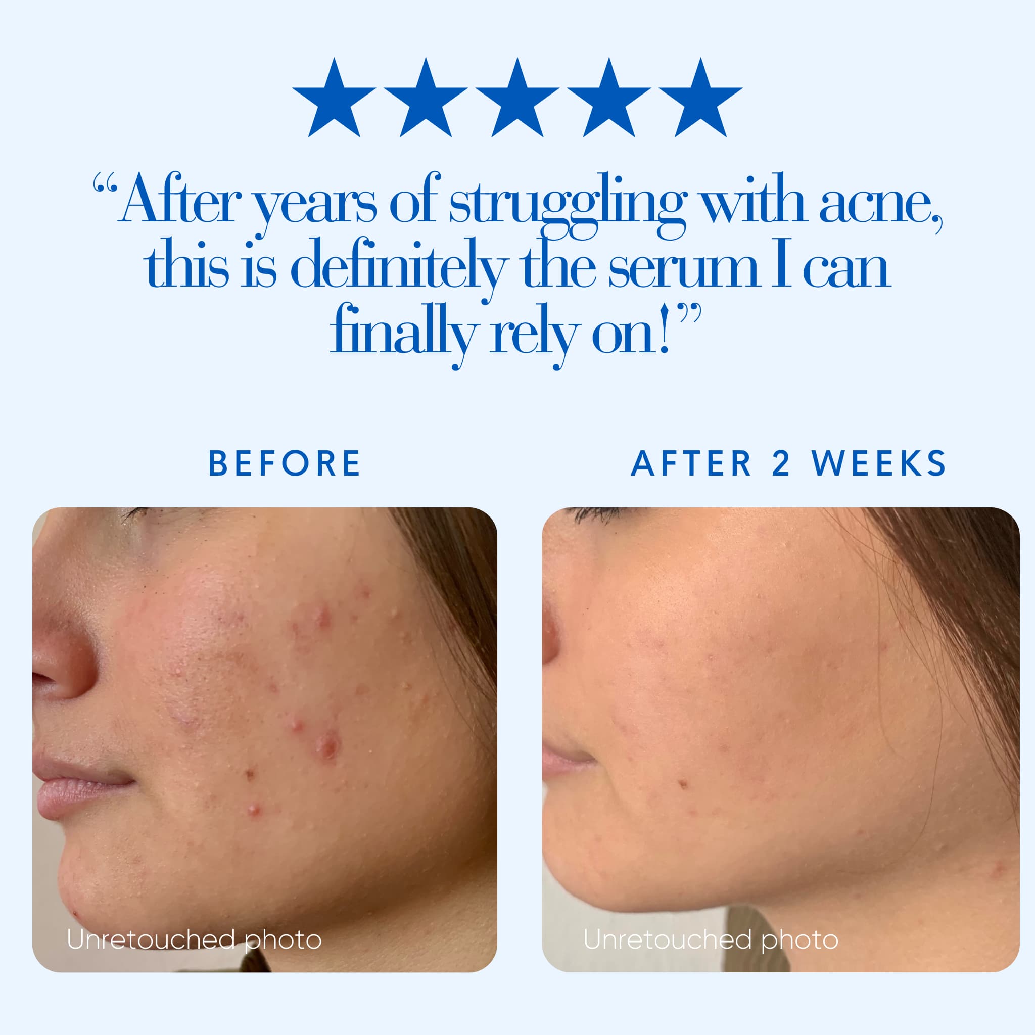 Before and after comparison of acne treatment serum with five-star rating and customer quote.