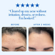 Before and after comparison of acne treatment with five-star rating and customer review.