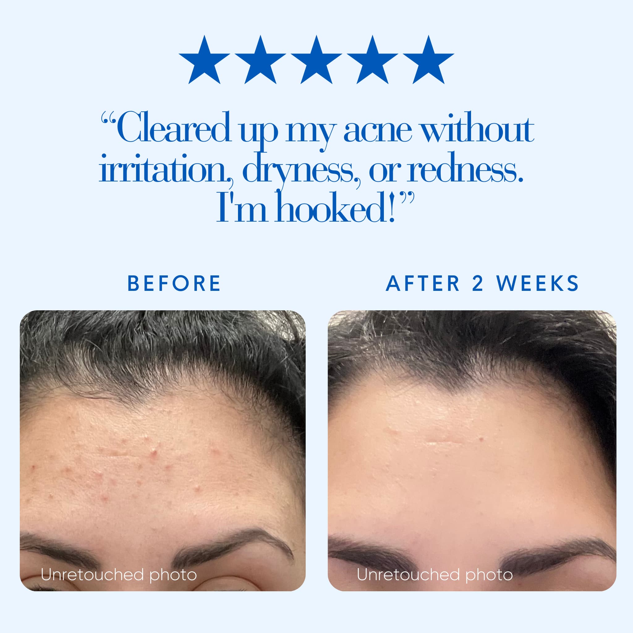 Before and after comparison of acne treatment with five-star rating and customer review.