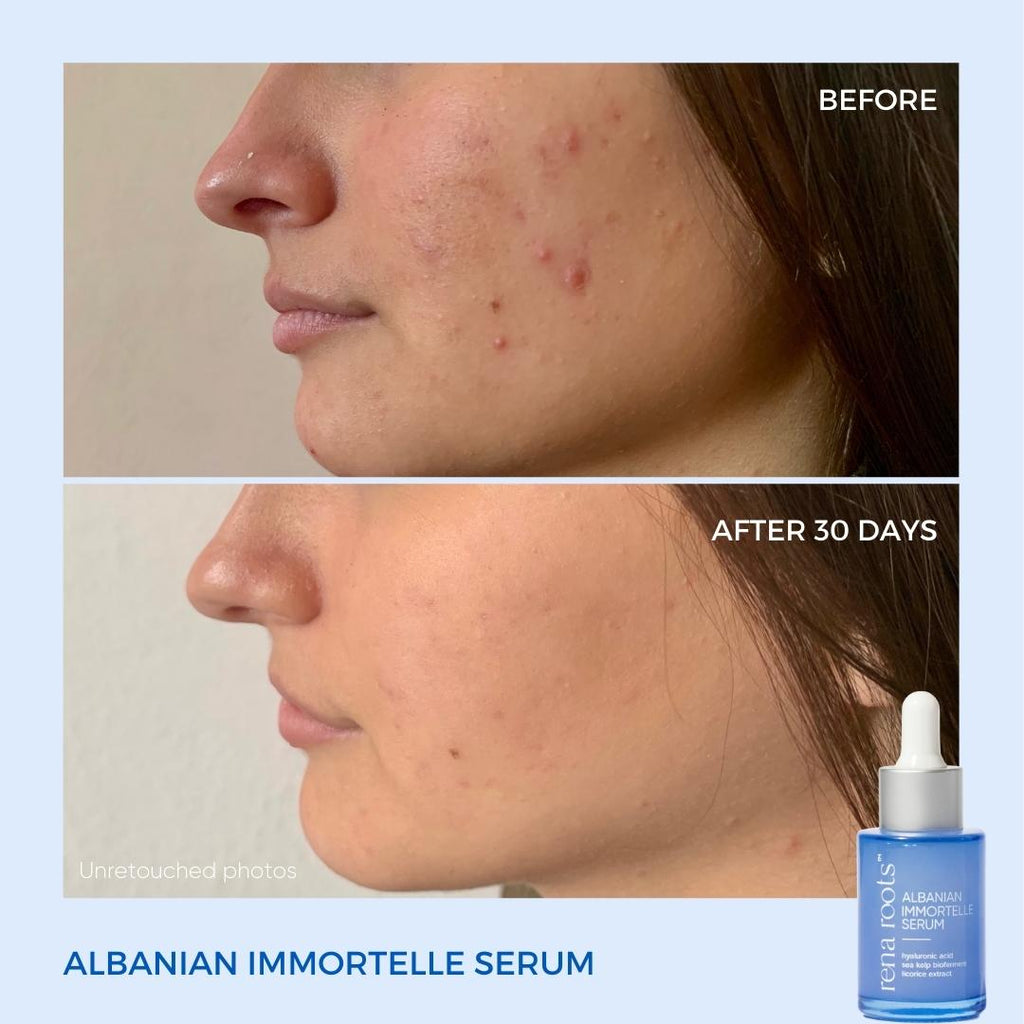 Albanian Immortelle Serum - Rescue Drops - Rena Roots™